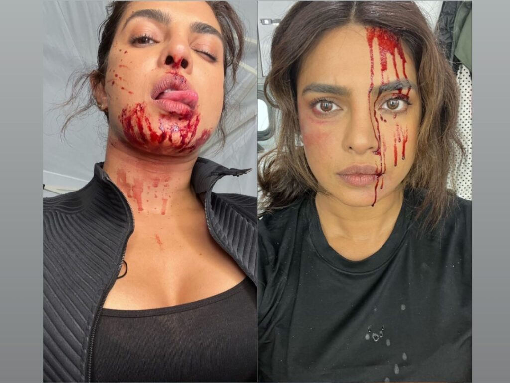 Priyanka Chopra Face Injury: प्रियंका चोपड़ा को आई गंभीर चोट, माथे और मुह से निकल रहा है खून